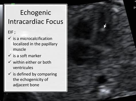 echogenic intracardiac focus pregnancy